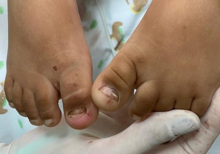 Criança de 3 anos tem duas unhas arrancadas e trauma no intestino