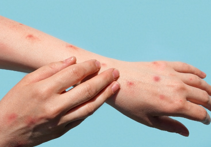 Brasil tem mais de 200 casos confirmados de varíola dos macacos